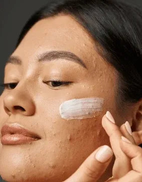 Aichun Beauty Acne Treatment Gel 20g Dubai UAE lightweight acne care gel for clearer looking skin and everyday facial skincare routine
